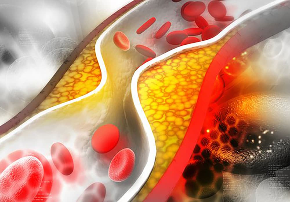 تأثیر Phaseolus Vulgaris بر LDL، HDL و تری گلیسیرید