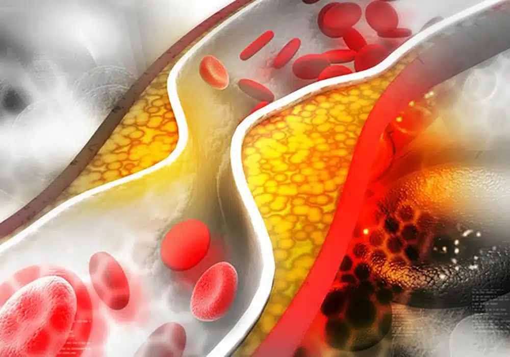 تأثیر Phaseolus Vulgaris بر LDL، HDL و تری گلیسیرید